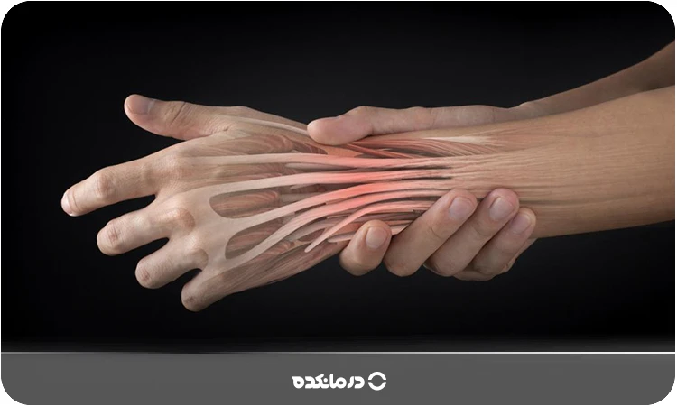 تاندون دست؛ [علائم پارگی + ۵ راه درمان پزشکی و خانگی]
