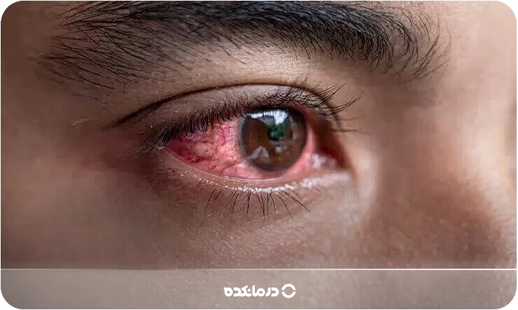 سکته چشمی چیست؟ [علت، انواع و علائم + ۶ روش درمان]