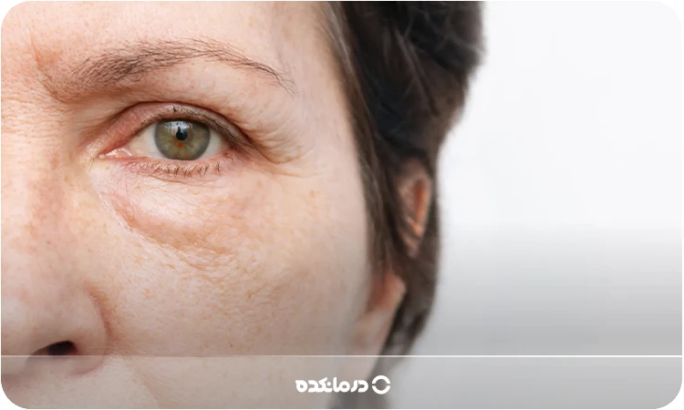 پف زیر چشم؛【۷ علت شایع + ۴ روش درمان قطعی】