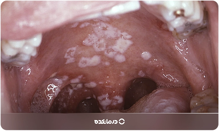 برفک دهان چیست؟ علت، علائم شایع + ۵ درمان موثر برای آن