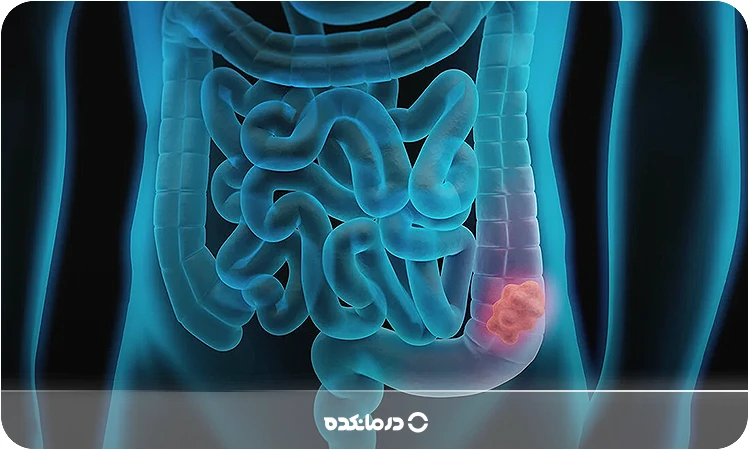 راه درمان انسداد روده چیست؟ 12 روش درمانی دارویی و خانگی